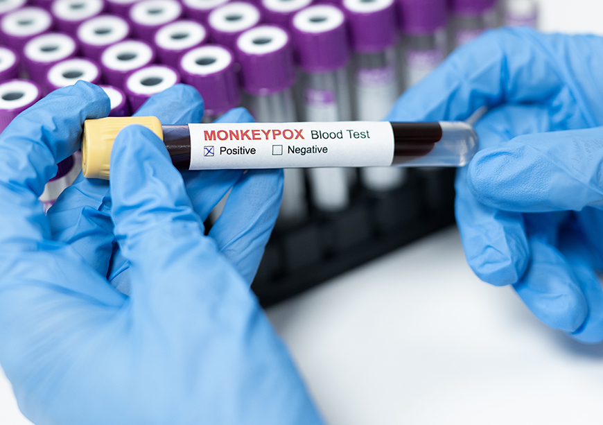 Mpox चा उद्रेक: भारतासाठी लस तयार करण्याची योग्य वेळ  
