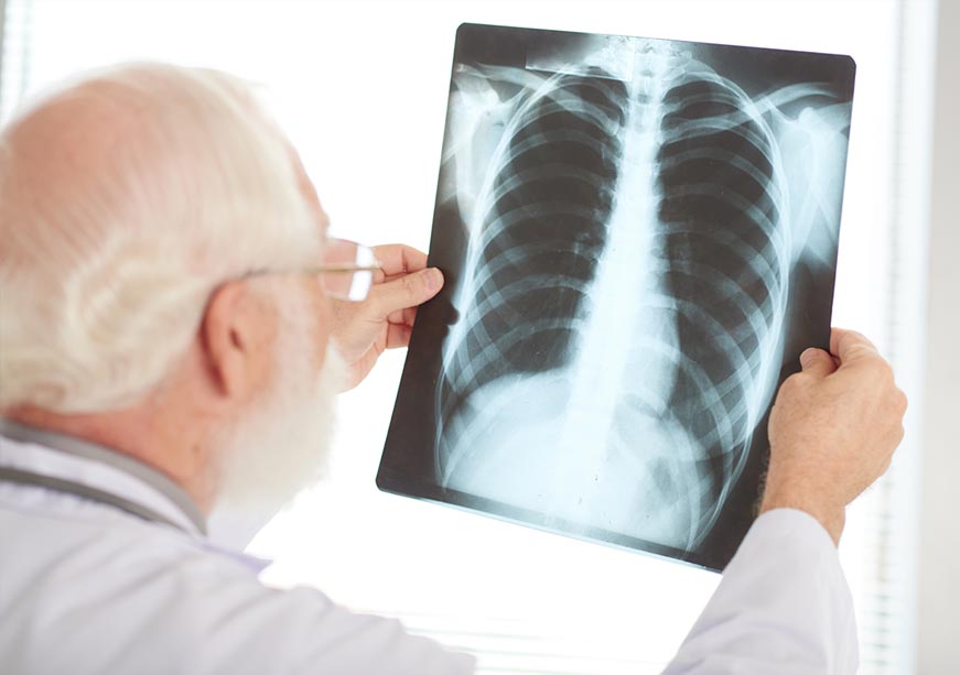 Clearing the Air for TB-Free India: The Last Mile Imperative  