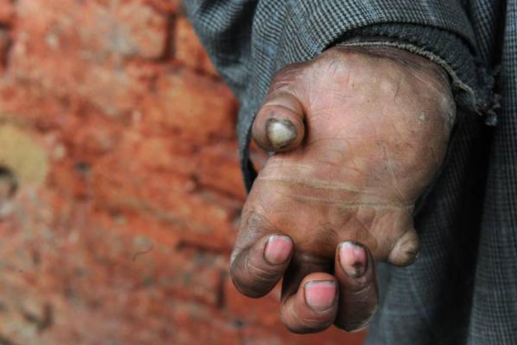 India’s Leprosy Challenge: Slow Gains and Lingering Inequities  