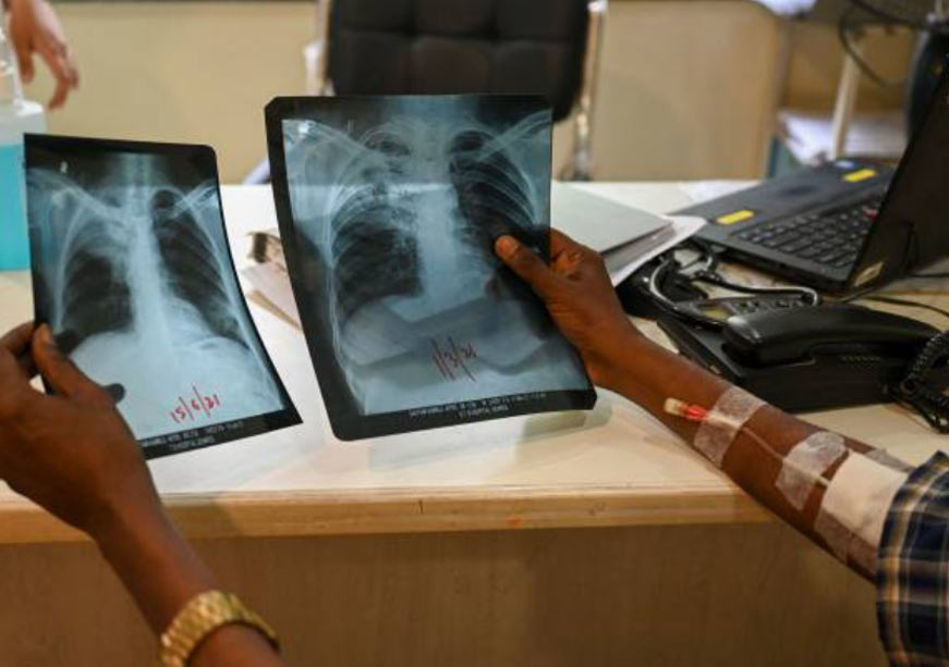 Financing India’s Fight to End Tuberculosis  